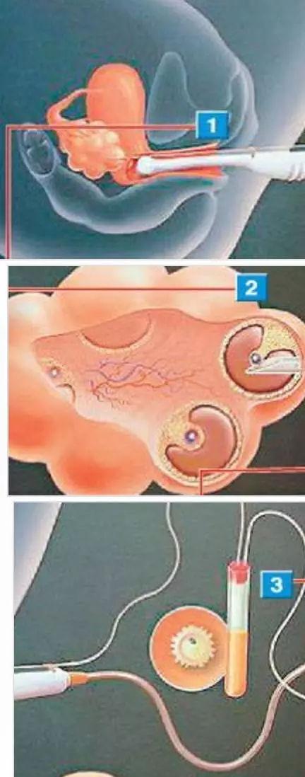 供卵女孩(供卵女孩：生育之路的选择与挑战”)
